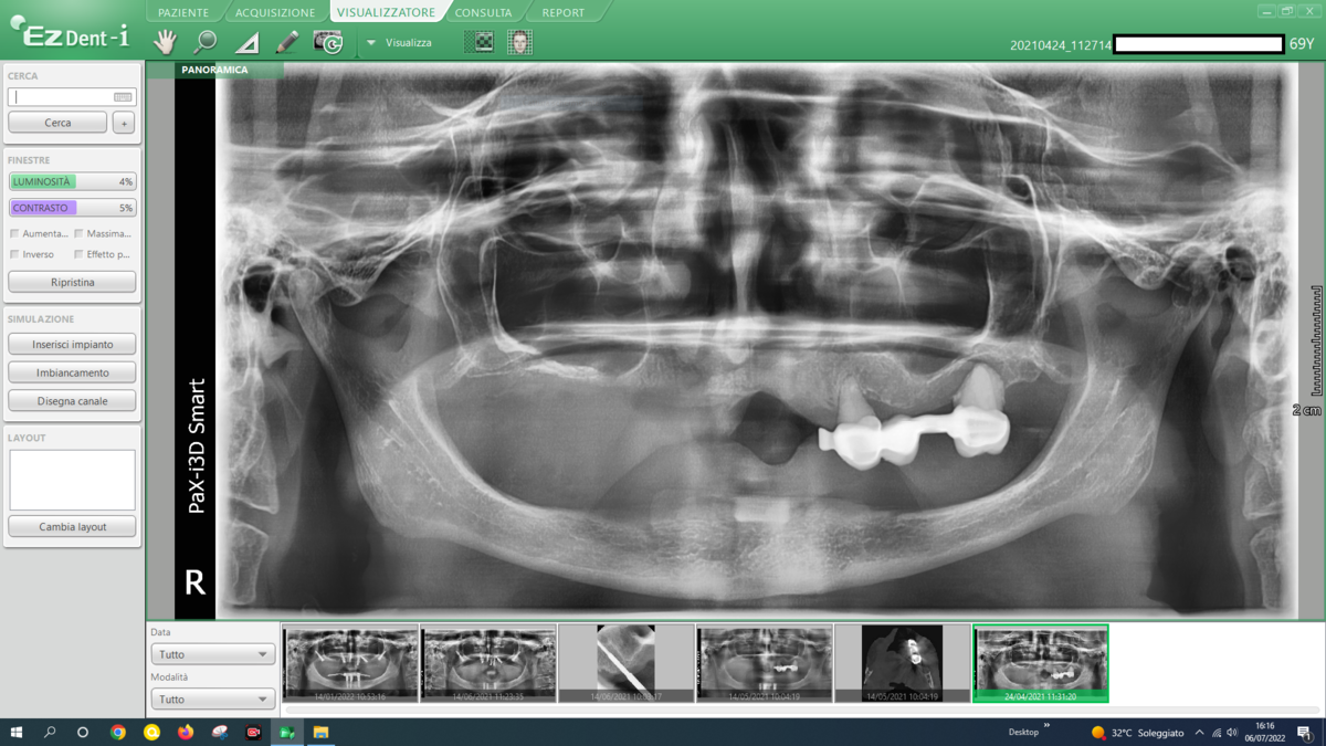Caso clinico 13 — dopo: riabilitazione completa con BSS™ o All-on-Full®