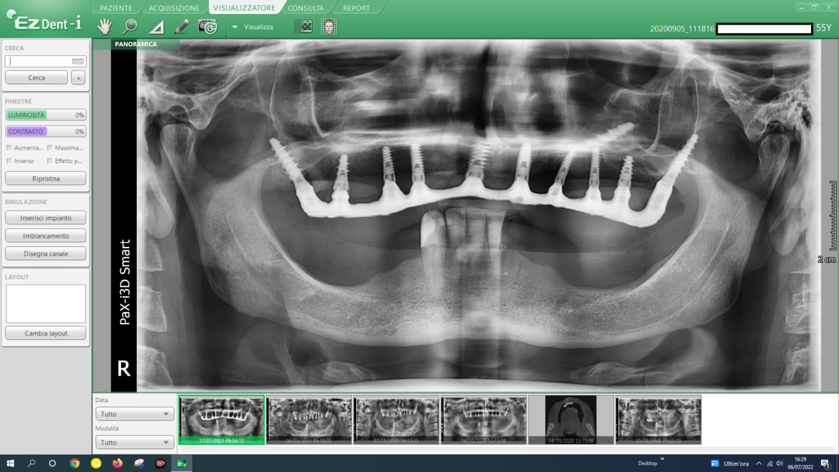 Caso clinico 41 — dopo: riabilitazione completa con BSS™ o All-on-Full®