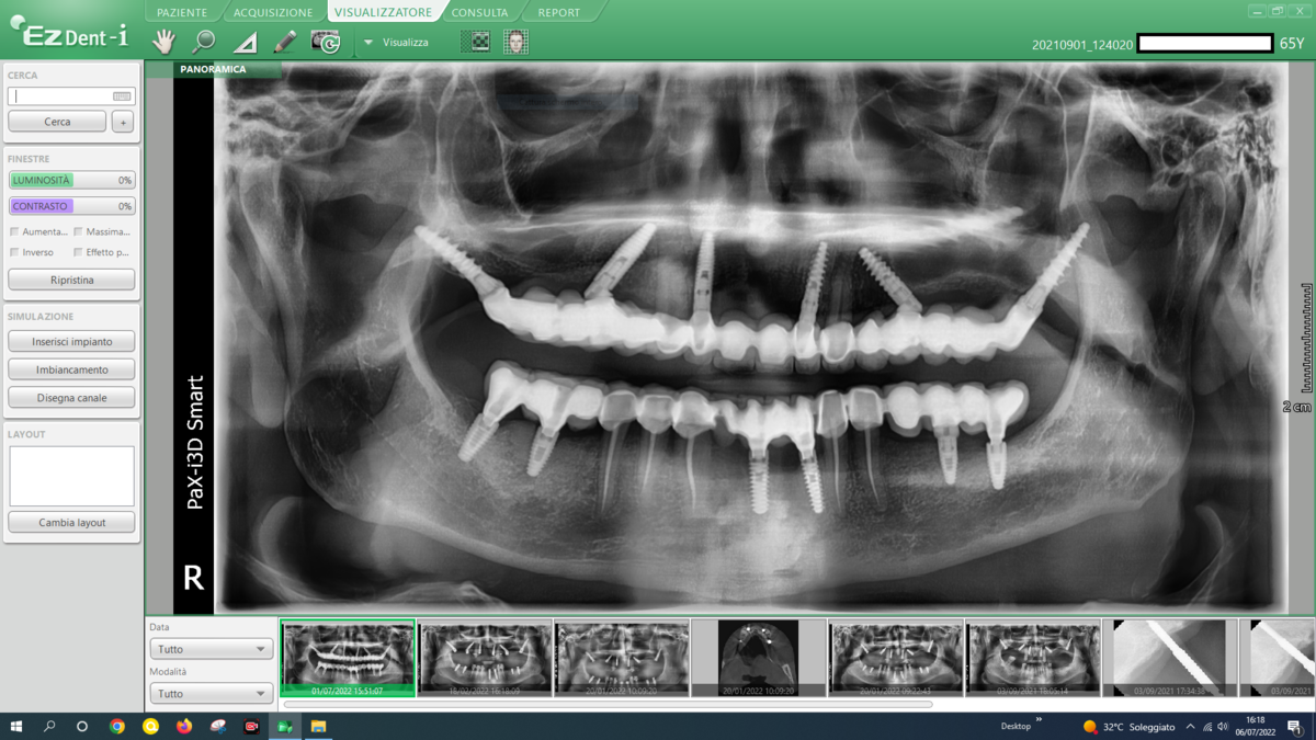 Caso clinico 7 — dopo: riabilitazione completa con BSS™ o All-on-Full®