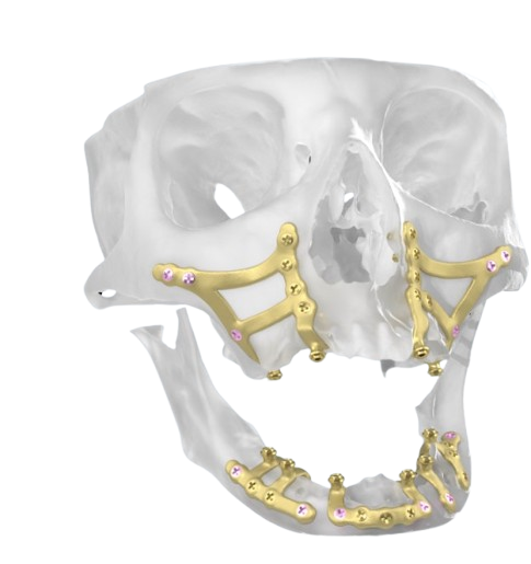 Implantologia a Griglia Sottoperiostea e Impianti Basali posteriori per tutti i molari a Milano: Denti Fissi senza Innesti Ossei
